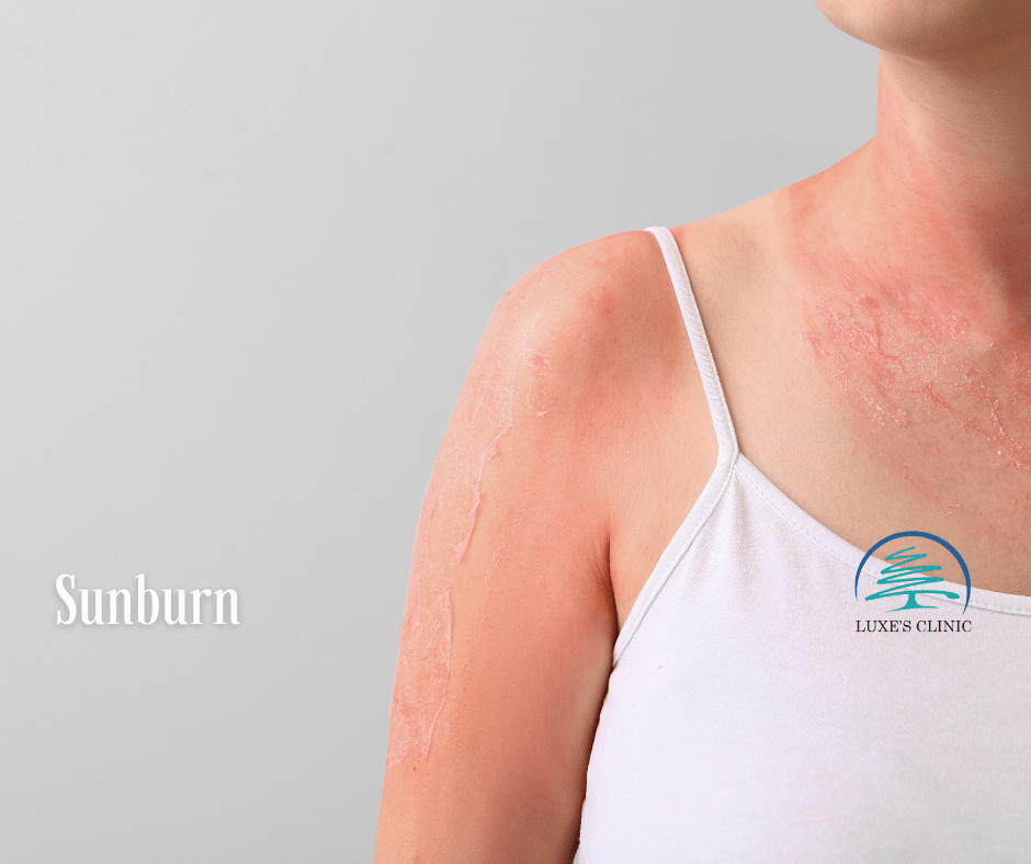 Professional Sunburn Treatment at Luxe's Clinic Sunburn Relief and